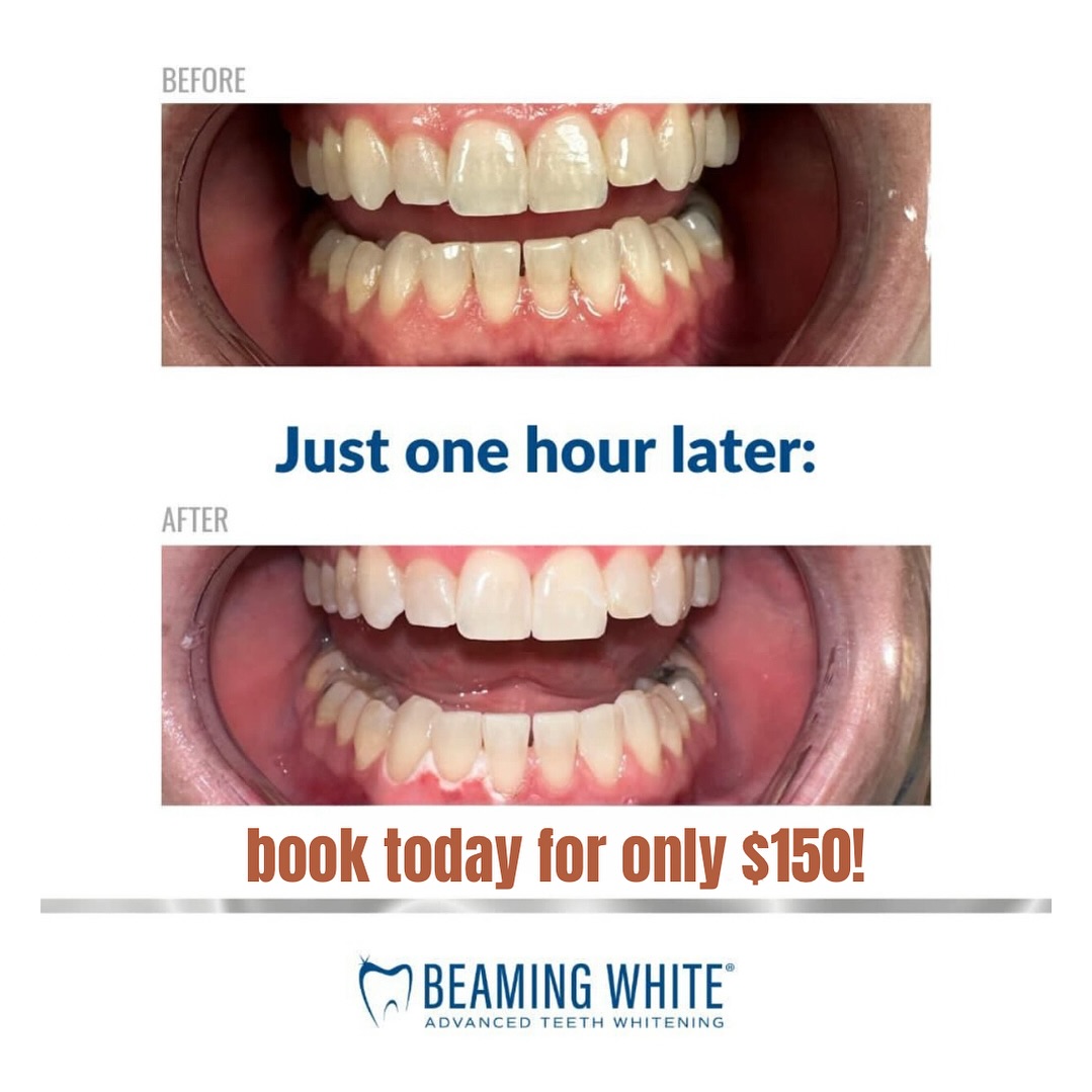 Book your teeth whitening today! Up to 4 shades lighter for only $150!
#coralsprings