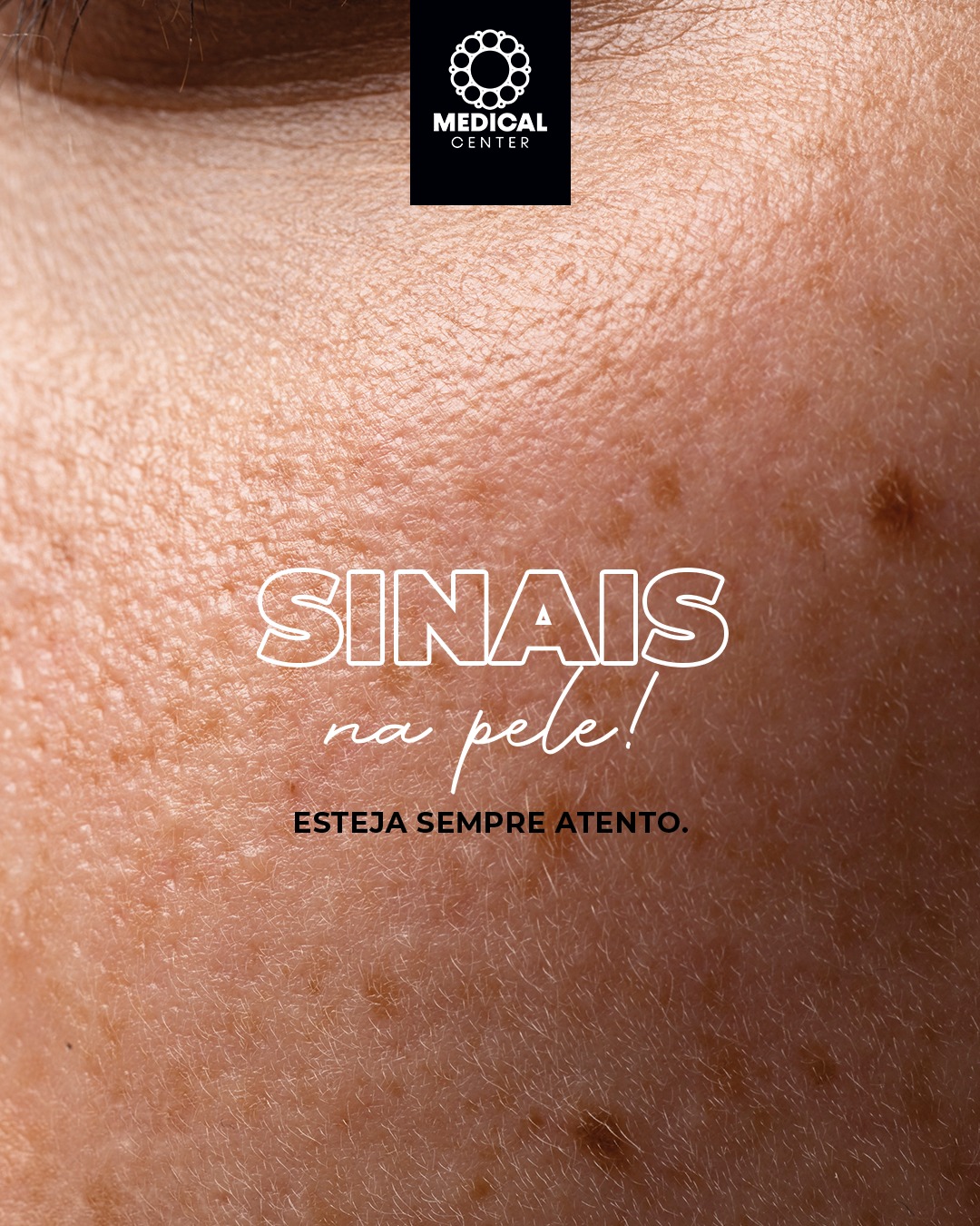 ✨🧬 A pele é um espelho do organismo.
Alterações dermatológicas podem indicar desequilíbrios hormonais, déficits nutricionais, inflamação, estresse, tireoide desregulada e até problemas gastrointestinais.
👀 Atenção aos sinais:
. Espinhas persistentes
. Queda de cabelo
. Unhas fracas
. Coceiras e vermelhidão
. Oleosidade ou secura extrema
Seu corpo fala pela pele. Interpretar cedo evita complicações.
A Medical Center cuida de você com ciência e acolhimento. 💙🌿
🌿 #VemEstarBem na #MedicalCenter
#Dermatologia #SaúdeDaPele #BemEstar #SaúdeIntegrada