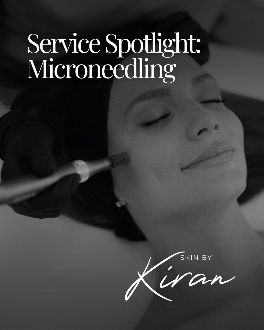 โจ Service Spotlight: Microneedling โจ
Microneedling is one of my go-to treatments for improving skin texture, tone, and overall skin health โ and itโs loved for good reason.
This advanced treatment works by creating tiny micro-injuries in the skin to stimulate natural collagen and elastin production, helping the skin repair and renew itself from within.
โจ Benefits of Microneedling:
โข Improves fine lines and wrinkles
โข Helps with acne scarring and pigmentation
โข Refines pores and skin texture
โข Boosts collagen production
โข Enhances skin firmness and glow
Results continue to improve over the weeks following treatment as collagen levels increase, making it perfect if youโre planning ahead for an event or simply investing in long-term skin health.
๐ Skin By Kiran โ Calder Podiatry, Sowerby Bridge
๐
Book your microneedling consultation via Booksy and start your glow-up journey โจ