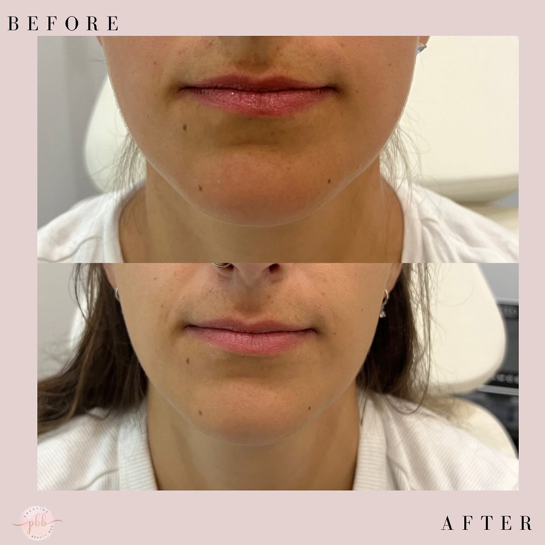 Toxin injections in the masseter muscle offer several benefits, both cosmetic and therapeutic. Cosmetically, they can help slim and contour the jawline, creating a softer, more balanced facial appearance, particularly for individuals with a square or bulky jawline.
Therapeutically, masseter tox is highly effective in relieving symptoms of teeth grinding (bruxism) and jaw clenching, which can lead to headaches, jaw pain, and excessive tooth wear. By relaxing the overactive muscle, neurotoxin reduces tension and discomfort, improving overall quality of life. Additionally, it can help prevent future complications associated with chronic clenching or grinding.
.
.
To book an appointment, visit our website:
š www.prestigebeautybarinc.ca
.
.
.
.
#humberbay #prestigebeautybar #sculptra #neuromodulator #injections #massterbotox #dermalfillers