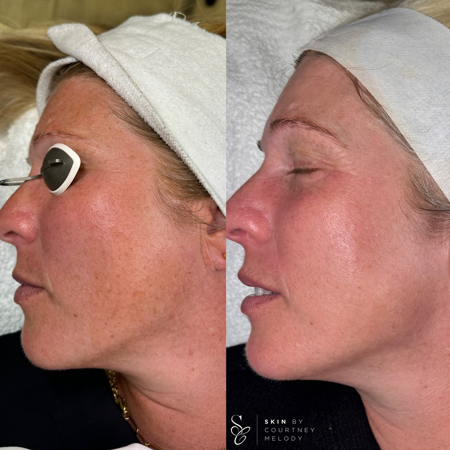 The power of good skincare & regular IPL treatments ⚡️
Pigmentation doesn’t just “appear” on the skin, it’s the result of overactive melanocytes.
Melanocytes are specialised cells in the basal layer of the epidermis. Their job is to produce melanin (pigment) as a natural form of protection against UV damage. In a healthy rhythm, this process is controlled and balanced. But when melanocytes are overstimulated and triggered by UV exposure, hormones, heat, inflammation, or injury to the skin, they can start producing irregular, excess pigment. This shows up as sun spots, post inflammatory hyperpigmentation, or uneven tone.
IPL (Intense Pulsed Light) works by targeting that excess melanin. The light energy is absorbed by the pigment, heating it up and breaking it down into smaller particles that the body can then naturally clear away. What’s clever is that the surrounding skin remains unharmed. IPL is selective, focusing only on pigmented clusters - I use the @venus.ai.uk_ire versa device! 💡
But it’s not just about fading dark spots. IPL also stimulates collagen production, reduces vascular redness, and improves overall skin quality. That’s why, in this result, you can see not only a drastic reduction in pigmentation, but also refined texture and a healthier, more radiant complexion.
This is skin that isn’t just clearer, it’s functioning better & NOW is the time for IPL whilst we’re hitting autumn & winter 🍂💡 #hyperpigmentation #pigmentation #melanocytes #cheltenham #skinclinic #cheltenhamskinclinic #ipl