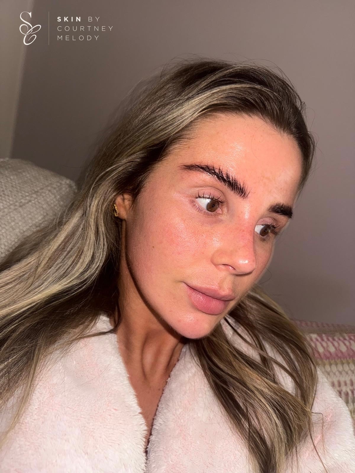 Client pictures - swipe for a before image🪞
This client’s journey has been a full 360° transformation! Her main concerns included uneven skin tone, persistent redness, tight and sore sensations, scarring, and the occasional breakout. During the initial skin analysis, it was clear that her skin was extremely dehydrated meaning it lacked the water content needed for optimal enzyme function. When the skin is short on water, its natural enzymatic processes (such as desquamation and barrier repair) slow right down.
As always, the first step was restoring barrier integrity. We began with a series of BYONIK cold laser sessions to soothe inflammation and stimulate repair on a cellular level. At the same time, we restructured her home routine to focus on ceramides, antioxidants, and a tyrosinase inhibitor to protect and even the complexion.
Once the barrier was strong and symptoms of irritation had resolved, we progressed to advanced skin revision, alternating between SkinPen microneedling and the Decaar Algae Peel. This combination works to refine scarring, smooth texture, and reduce post-inflammatory pigmentation.
Normally, I adjust skincare gradually to avoid overwhelm, but this client was committed to full consistency from day one investing in both professional treatments and a tailored home plan.
The results speak for themselves & we couldn’t be happier!!! 🫶🏼