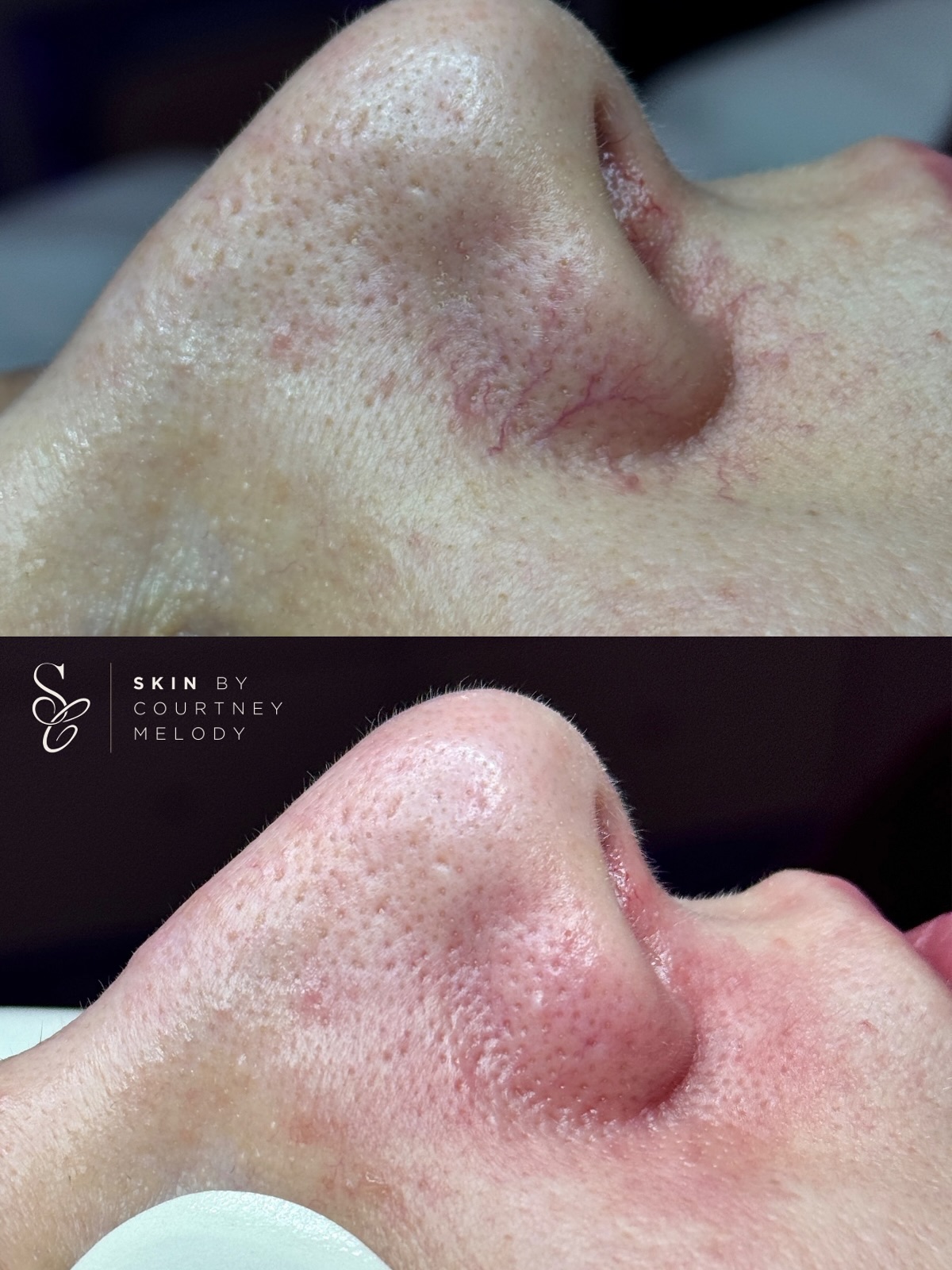 Gone in a flash ⚡️
Little broken veins around the nose are one of the most common concerns I hear about in clinic. They’re completely harmless, but if they bother you, they can absolutely be treated.
In clinic, I use my @venus.ai.uk_ire IPL device to target and remove visible veins or areas of redness. Using either the 515nm or 580nm handpiece, light energy is drawn into the skin and absorbed by the vessel, causing the blood inside to coagulate. The vein then becomes “sticky” and is gradually reabsorbed by the body.
It’s important to have realistic expectations, these vessels can reappear over time depending on their depth, size, and thickness. However, maintenance treatments can significantly reduce their recurrence.
You don’t need a consultation for IPL, just a quick patch test. Treatments can be booked per area, if you have any questions, feel free to message me! To book, simply head to my website 😊
*redness in surrounding area is normal post treatment*