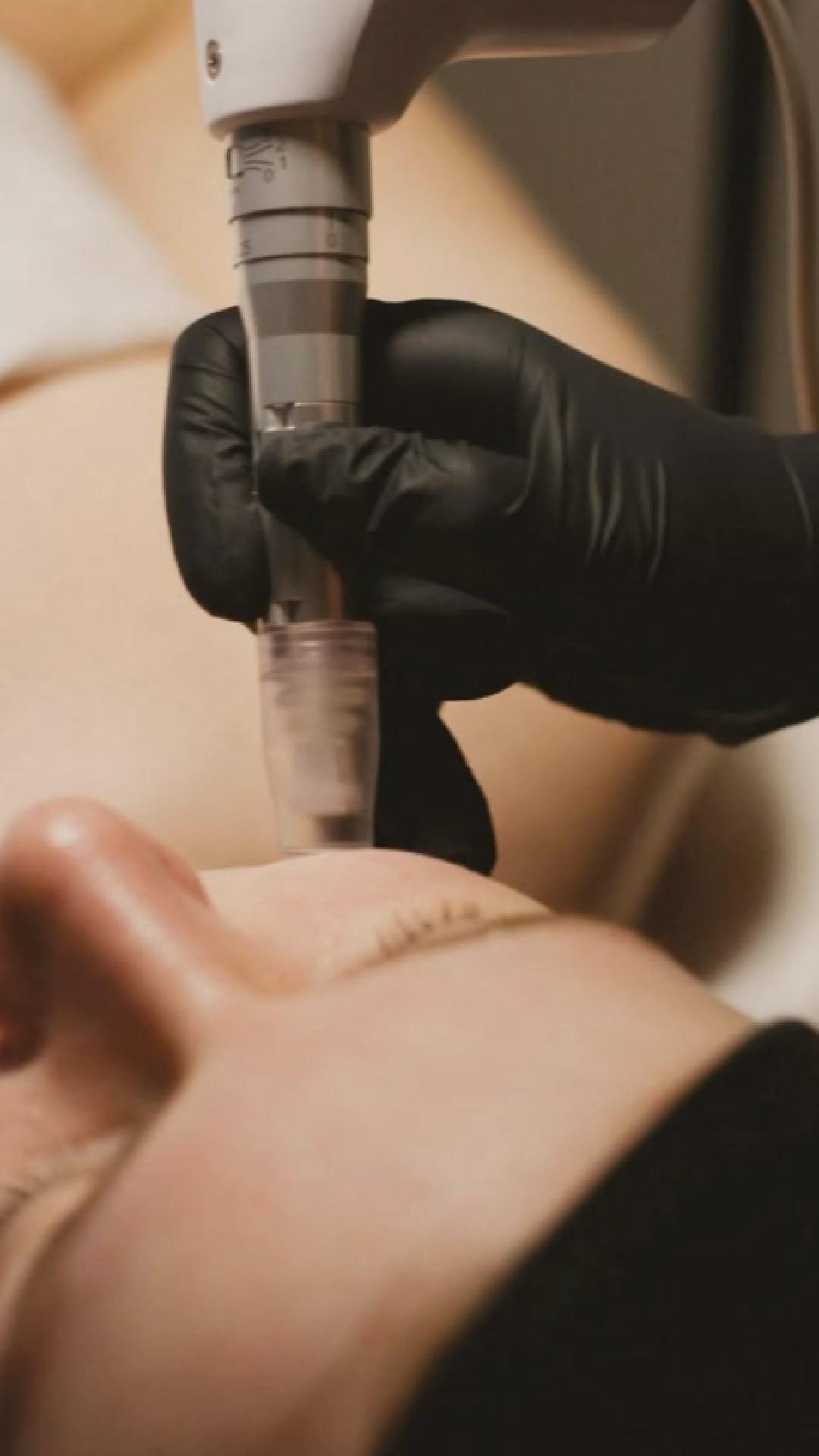 โจ Ready to reveal smoother, refreshed skin? โจ
Our Microneedling Facial with the Dermal Pen is designed to rejuvenate your complexion from the inside out. This treatment boosts collagen, softens fine lines and gives your skin a renewed, healthy glow youโll love on and off camera.
๐ Oak Brook, IL
๐ 224-407-2140
๐ Book today: www.medicalbeautycareclinic.com
๐ https://linktr.ee/medicalandbeauty
#MedicalBeautyCareClinic #SkinRejuvenation #Microneedling #DermalPen #FacialTreatment