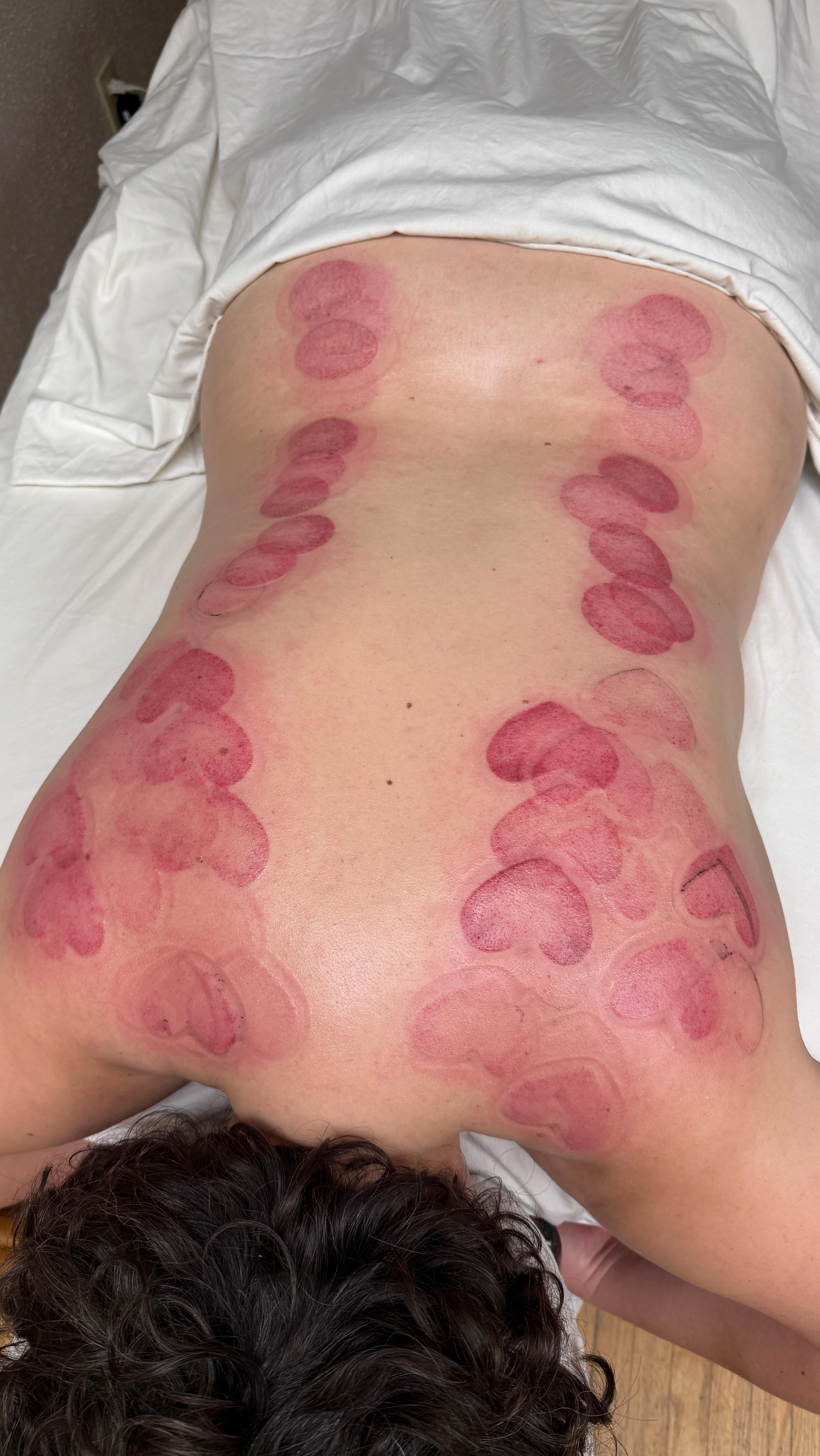 I 💕 cupping
#cuppingtherapy #chinesemedicine #acupuncture #cuppingmassage #acupuncturist