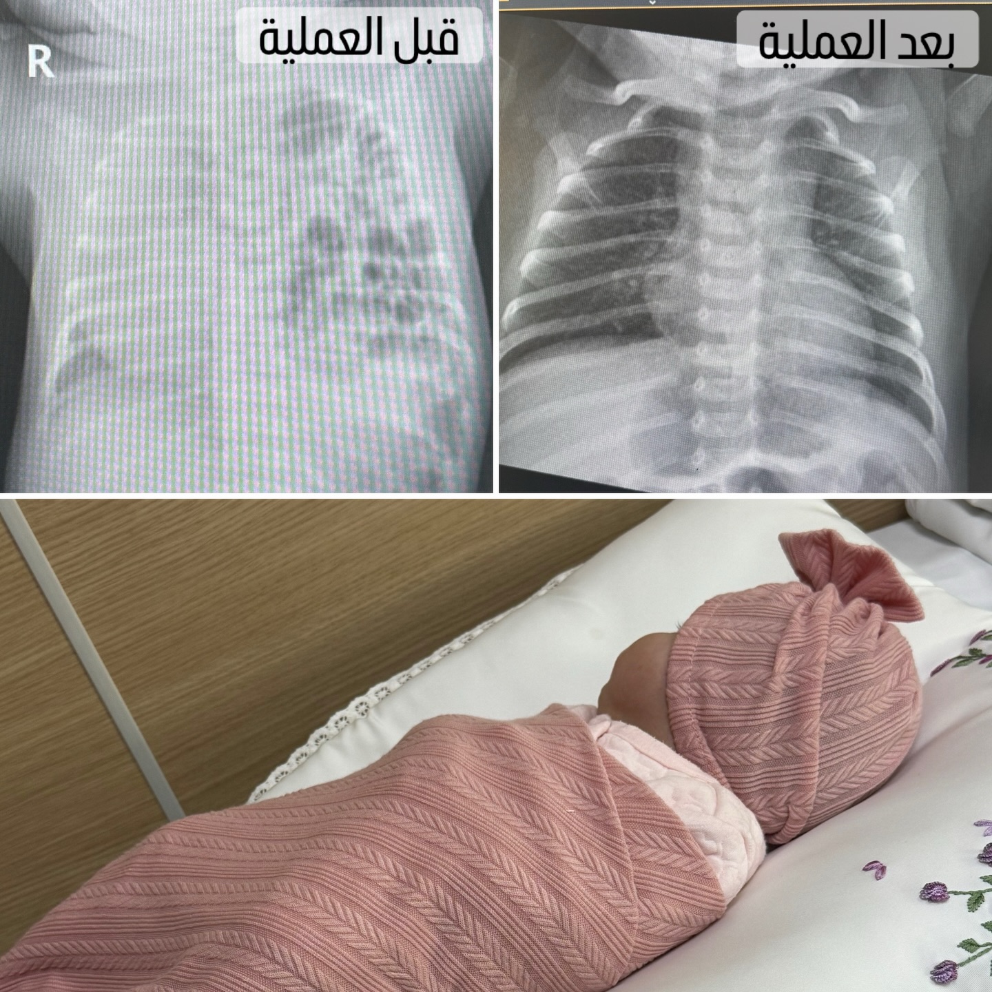  ✨ خبر جميل اليوم ✨
ماريا كان لها بداية صعبة مع فتق في الحجاب الحاجز أثّر على تنفّسها، واليوم بعد شهر من العملية، الحمدالله الأشعة ممتازة والرئة رجعت لوضعها الطبيعي💕
**📒فتق الحجاب الحاجز هو تشوّه خلقي يسمح بانتقال الأمعاء إلى الصدر ويضغط على الرئة، و يسبب صعوبة في التنفّس…