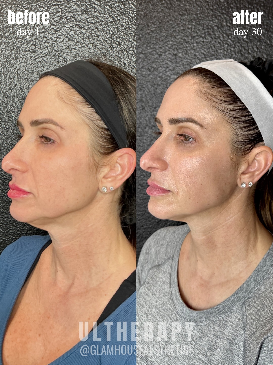 30 days after Ultherapy and the lift is already beginning to show. š
This patient came in wanting improvement in her neckline, early jowling, and midface laxity without surgery. Just 4 weeks after treatment, you can already see increased firmness through the jawline, a smoother neckline, and subtle lifting through the midface.
Ultherapy works by stimulating your bodyās natural collagen production deep beneath the skin, gradually tightening and lifting over time.
While these early changes are exciting, the full result is still developing & collagen remodeling continues for up to 6 months, meaning her results will continue to improve.
Non-surgical lifting, powered by your bodyās own collagen.
Glamhouse Aesthetics & Wellness | New Braunfels | New Braunfels MedSpa | San Antonio MedSpa | Ultherapy | Facial Rejuvenation