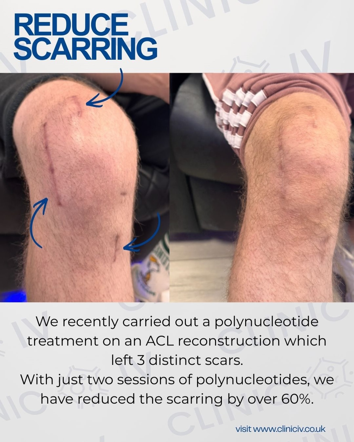 Scars don’t have to be permanent.
Following an ACL reconstruction, this patient was left with three distinct scars across the knee. After just two sessions of polynucleotides, the appearance of the scars has been reduced by over 60%.
Polynucleotides work by supporting skin regeneration, improving texture, and stimulating collagen in damaged tissue.
If you have surgical scars, injury scars, or stretch marks, regenerative treatments may be able to help.
📍Backwell, Bristol
🔬 Science-led aesthetic treatments
📲 Book via the link in bio
#scarreduction #polynucleotides #regenerativemedicine #aestheticclinic #skinrejuvination
